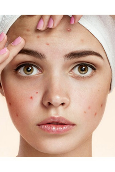 Esiti cicatriziali acne