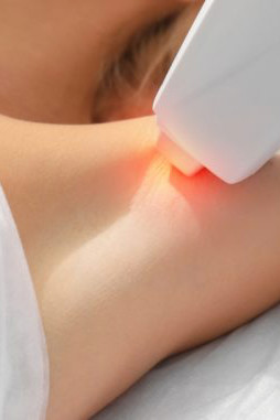 Epilazione permanente