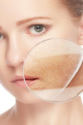 Eliminazione macchie solari