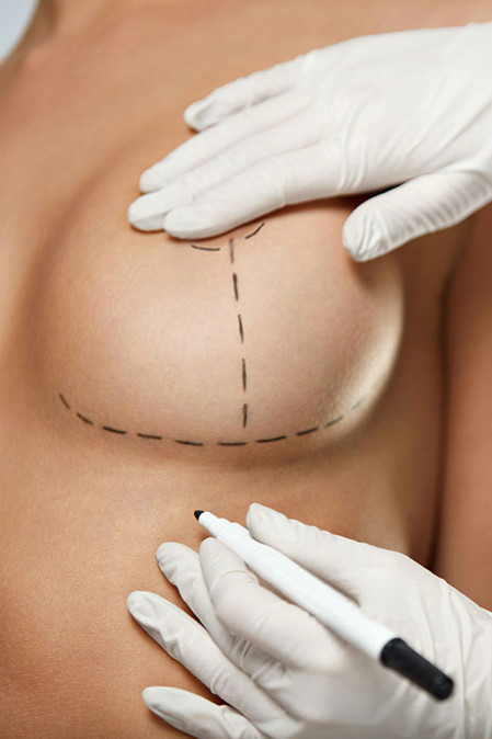 Mastoplastica riduttiva